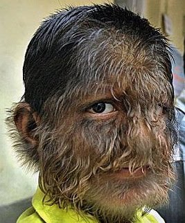 Russian Mainly Poetry Russian Hairy Face Disease
